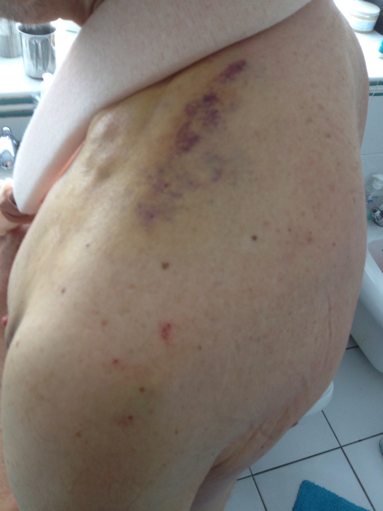 Left clavicle bruising over break