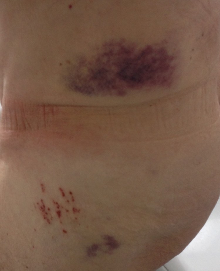 Rash at shorts, bruise under double Jersey